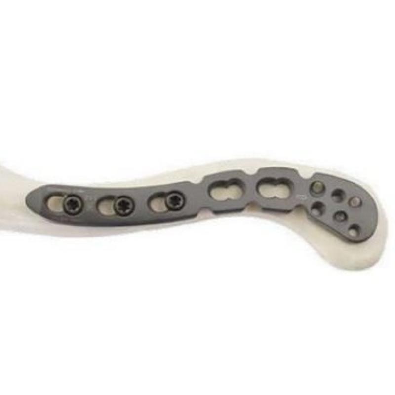 3.5 мм LCP Пластина ключична верхня -3 (титанова), ліва WegoOrtho